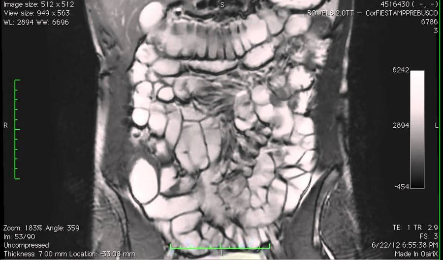 МРТ кишечника в Москве