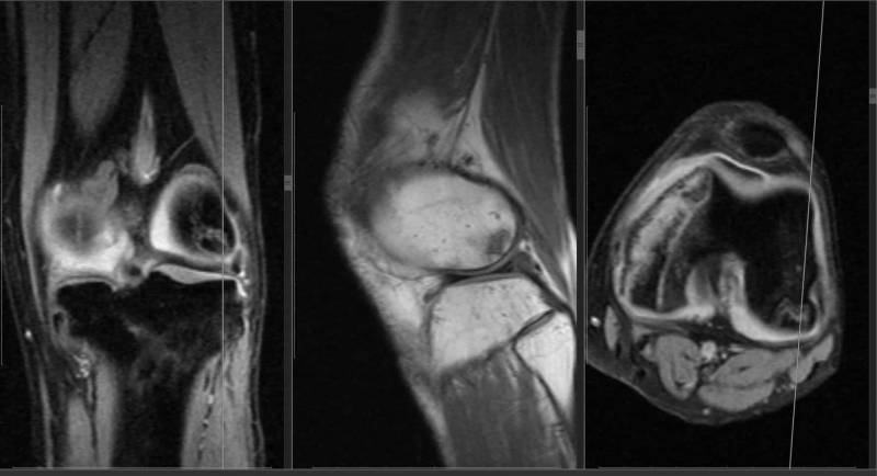 Магнитно-резонансная томография коленного сустава