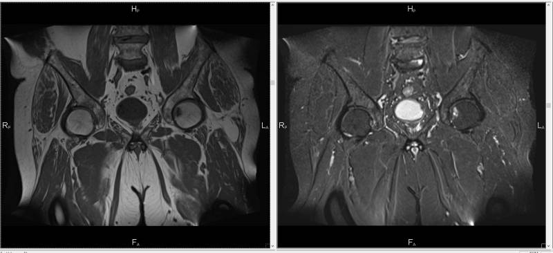 Магнитно-резонансная томография костей таза